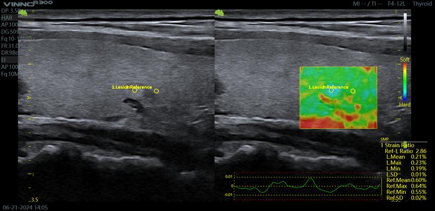 Máy siêu âm 5D Vinno R500